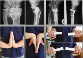 Handgelenkszertrümmerung durch einen Sportunfall. Rekonstruktion durch ein modernstes Implantat.