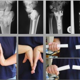 Handgelenkszertrümmerung durch einen Sportunfall. Rekonstruktion durch ein modernstes Implantat.