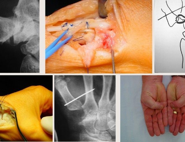 Klassische Operationsmethode mit körpereigenem Gewebe (Sehnentransplantation).