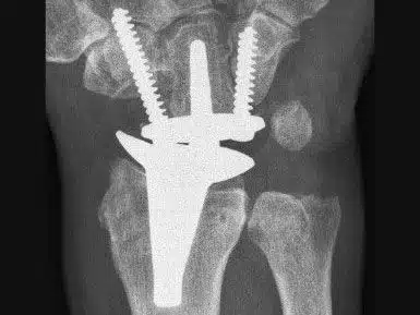 Handprothese